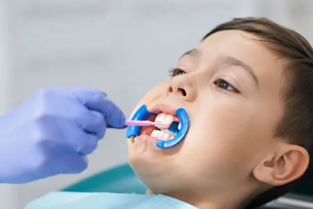 Dental sealant applied to teeth