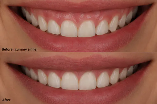 Gum contouring before and after results