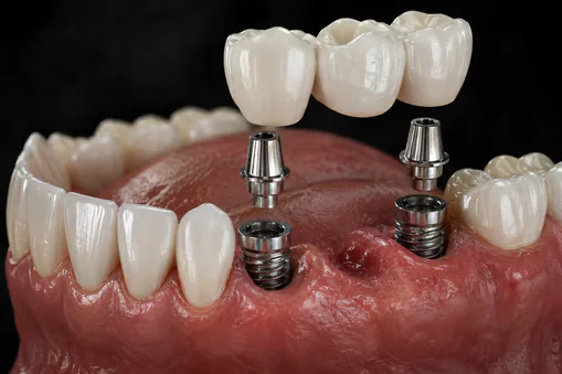 Implant supported bridge