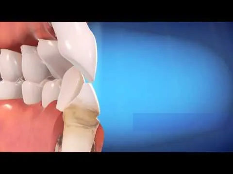 Invisalign® Vs Braces
