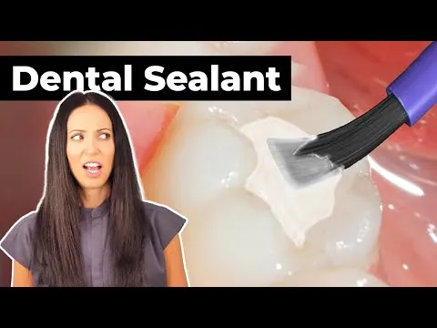 Who should get dental sealants