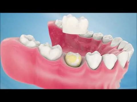 How Is a Dental Crown or Bridge Placed