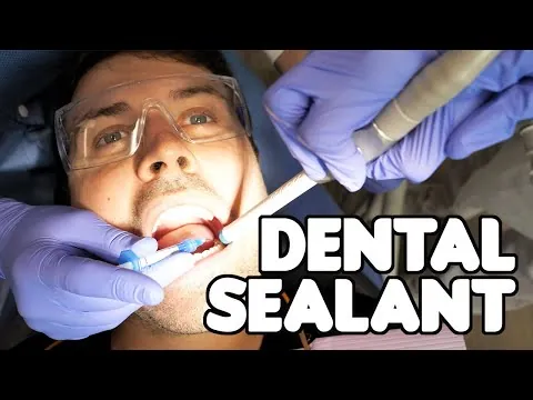 Dental sealants procedure