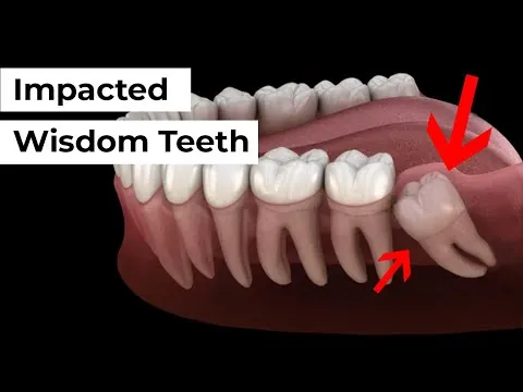 What are impacted wisdom teeth?