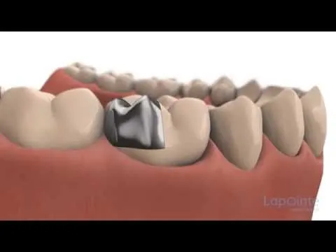 What are Inlays and Onlays