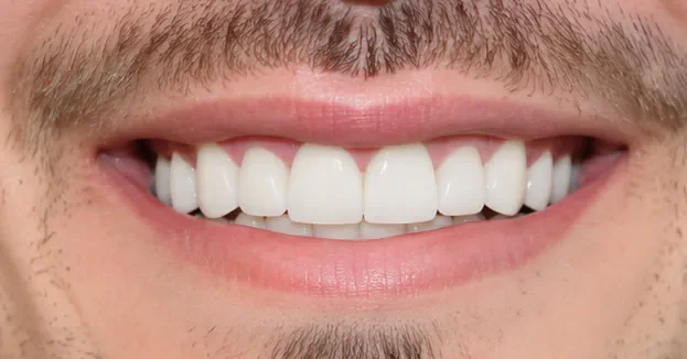 before full mouth restoration mouth After full mouth restoration mouth