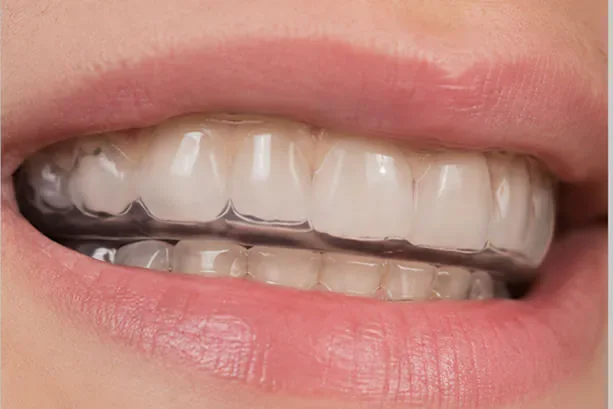 dental-mouthguard-splint-mouth-treatment-dysfunction-temporomandibular-joints-bruxism-malocclusion-relax-muscles-jaw bruxism mouth guard in mouth