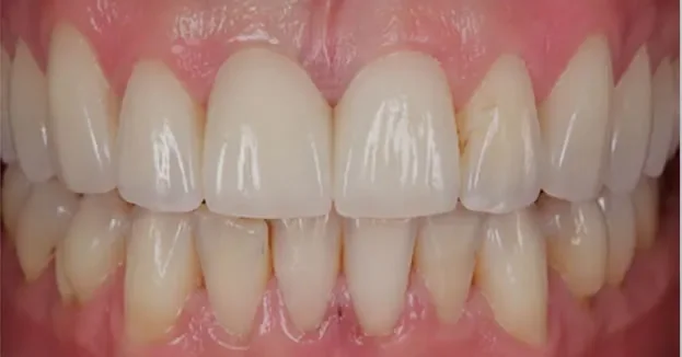 close up after dental bridge