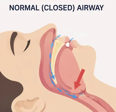 closed airway sleep apnea diagram