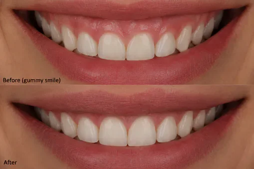 gum contoring before and after