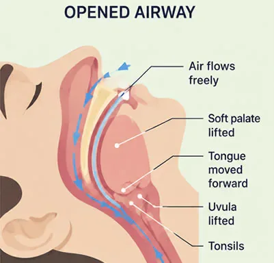 open-airway-sleep-apnea-diagram open airway sleep apnea diagram