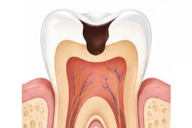 tooth cavity illustration