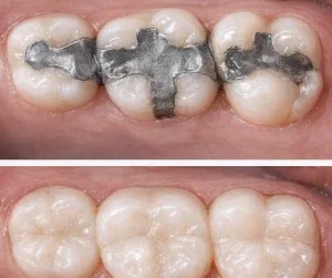 white fillings 1
