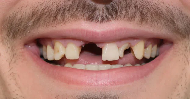 Before full mouth restoration mouth